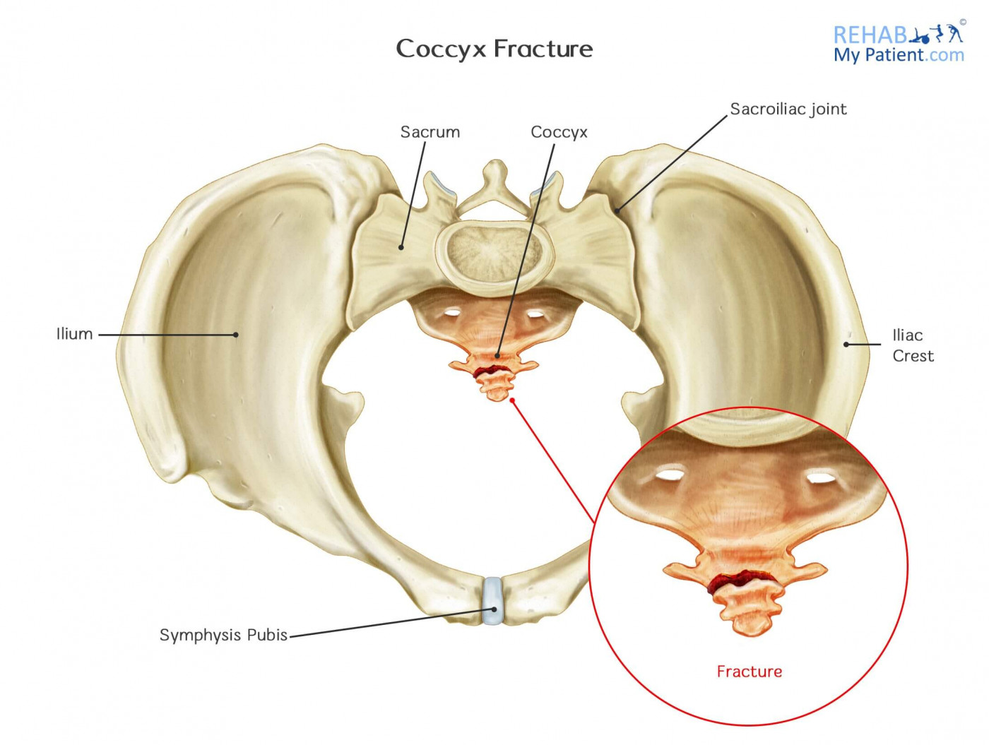 Tailbone Injury (Coccyx Injury): symptoms, causes, risk factors,  prevention, diagnosis, treatment, surgery, sleeping positions