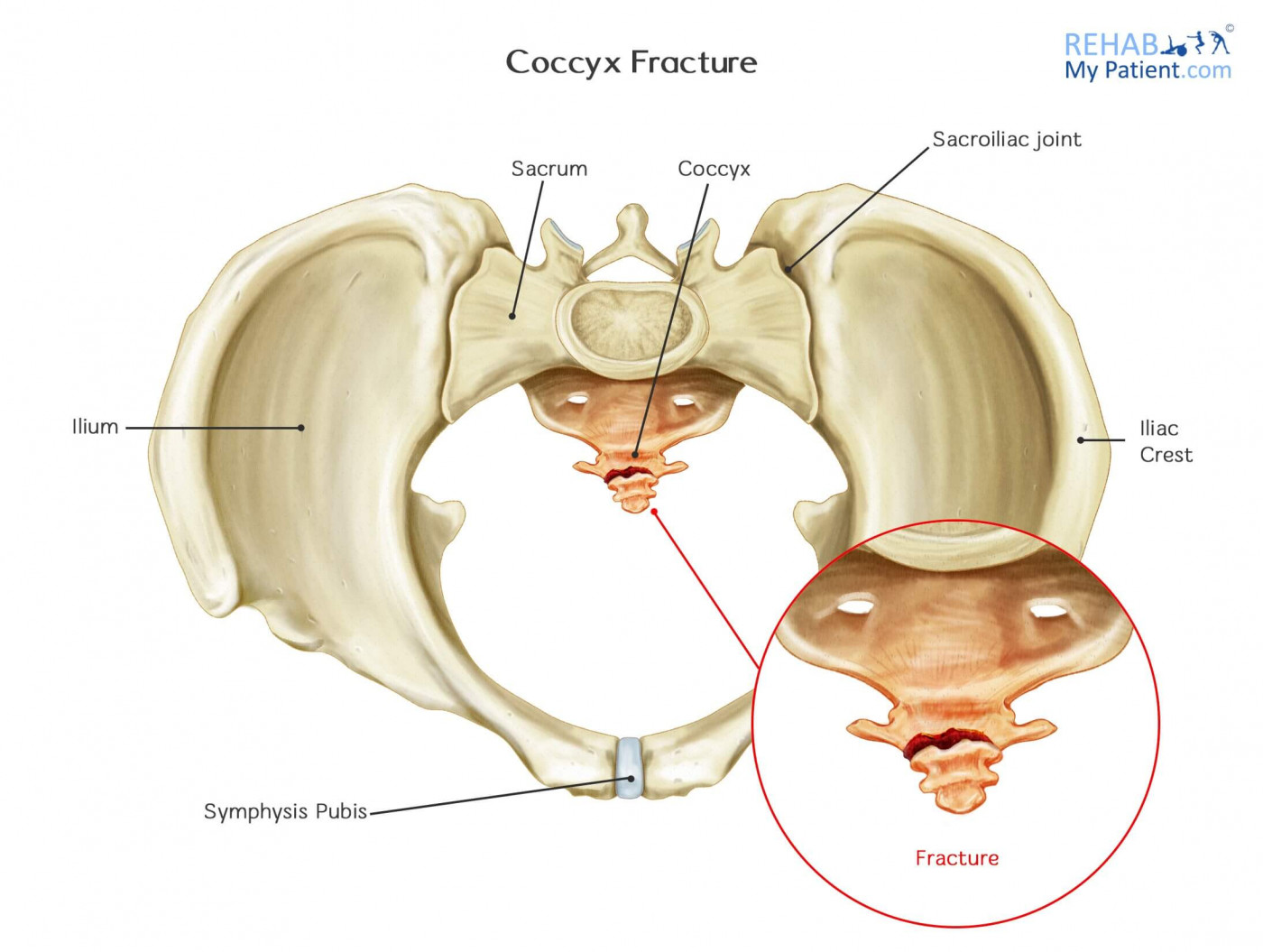 Broken Tailbone (Coccyx) In Children: Causes, Symptoms, And Treatment