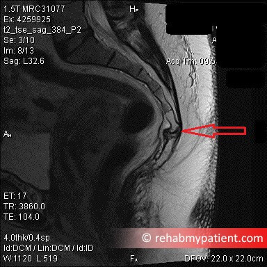 Coccyx Fracture MRI