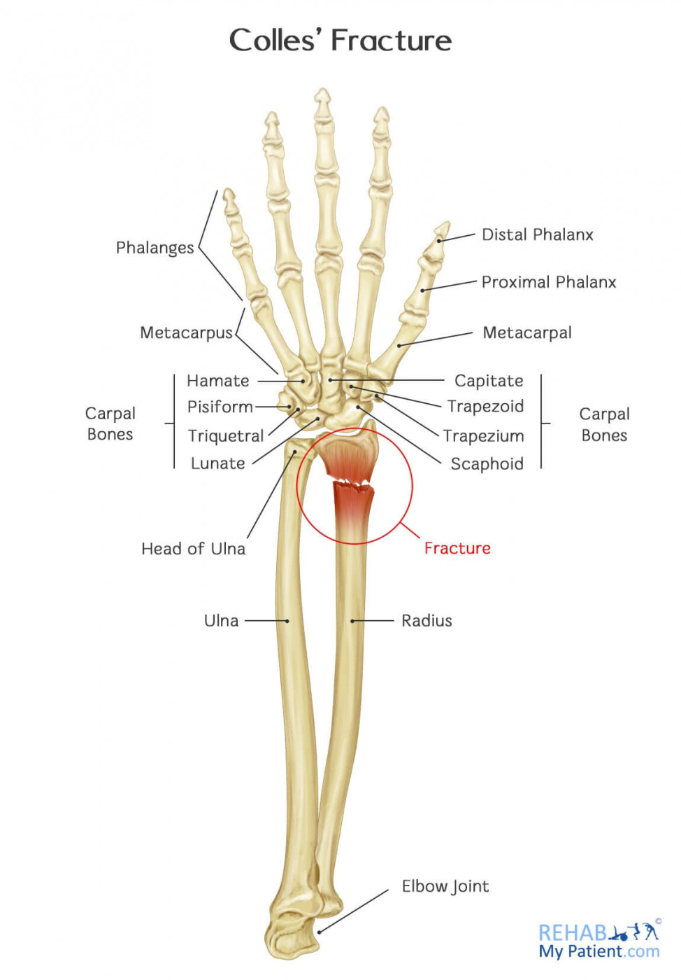 Colles' Fracture  Rehab My Patient