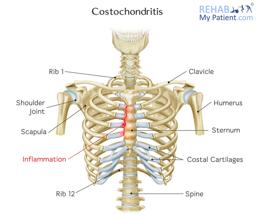 Costochondritis | Rehab My Patient