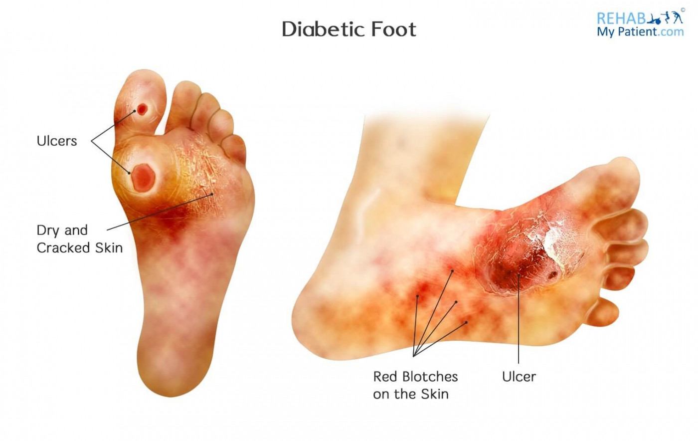 Diabetic Charcot Foot