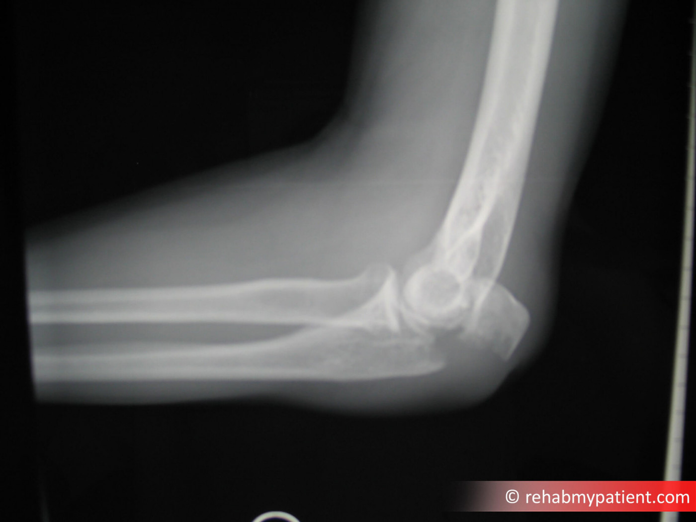 Elbow Olecranon Fracture X-Ray