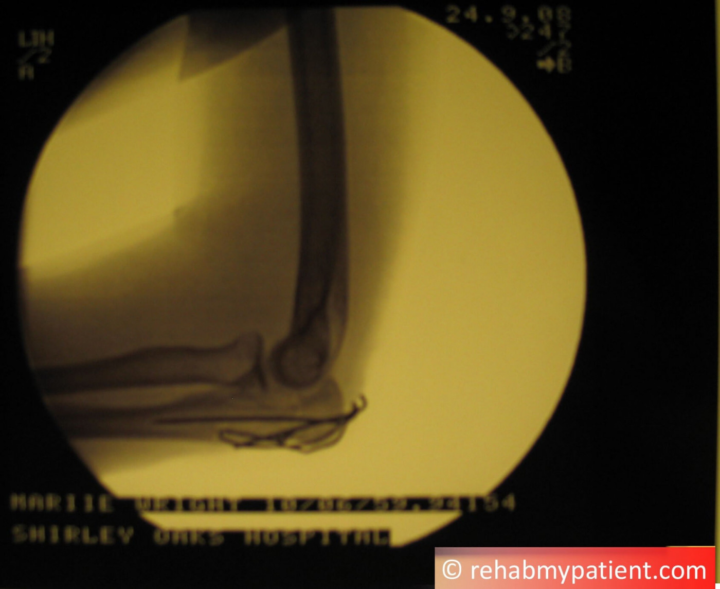 Elbow Olecranon Fracture X-Ray
