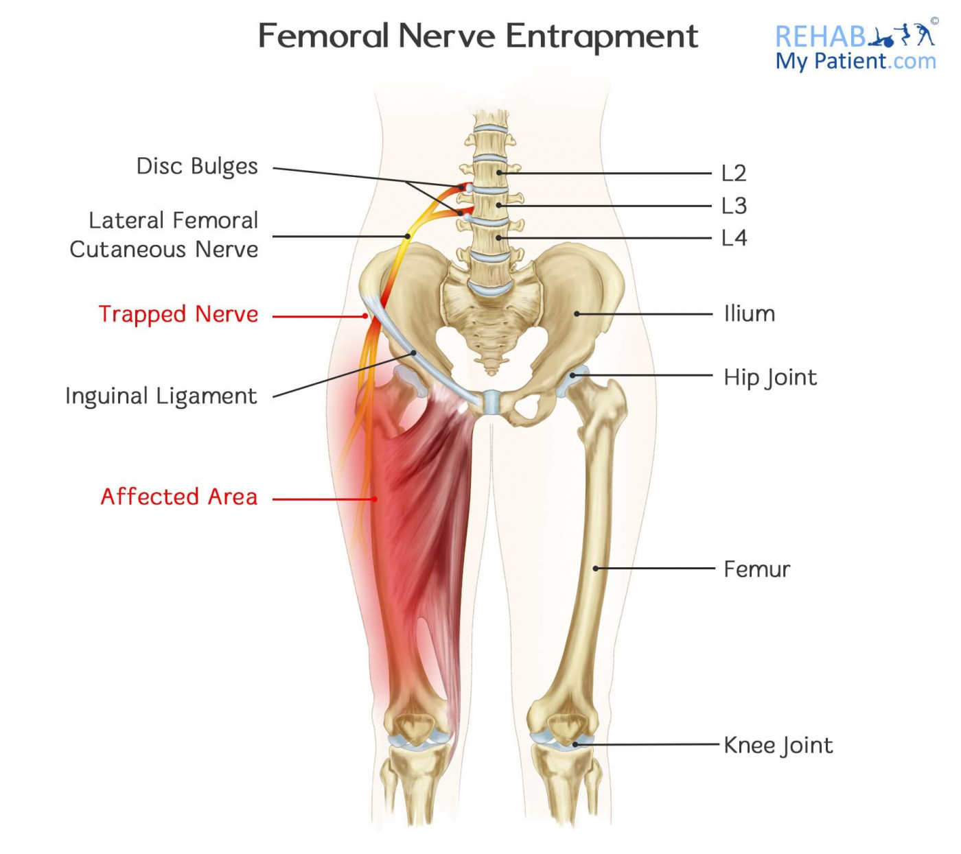 Pinched Nerve, Nerve compression: Symptoms & Treatment