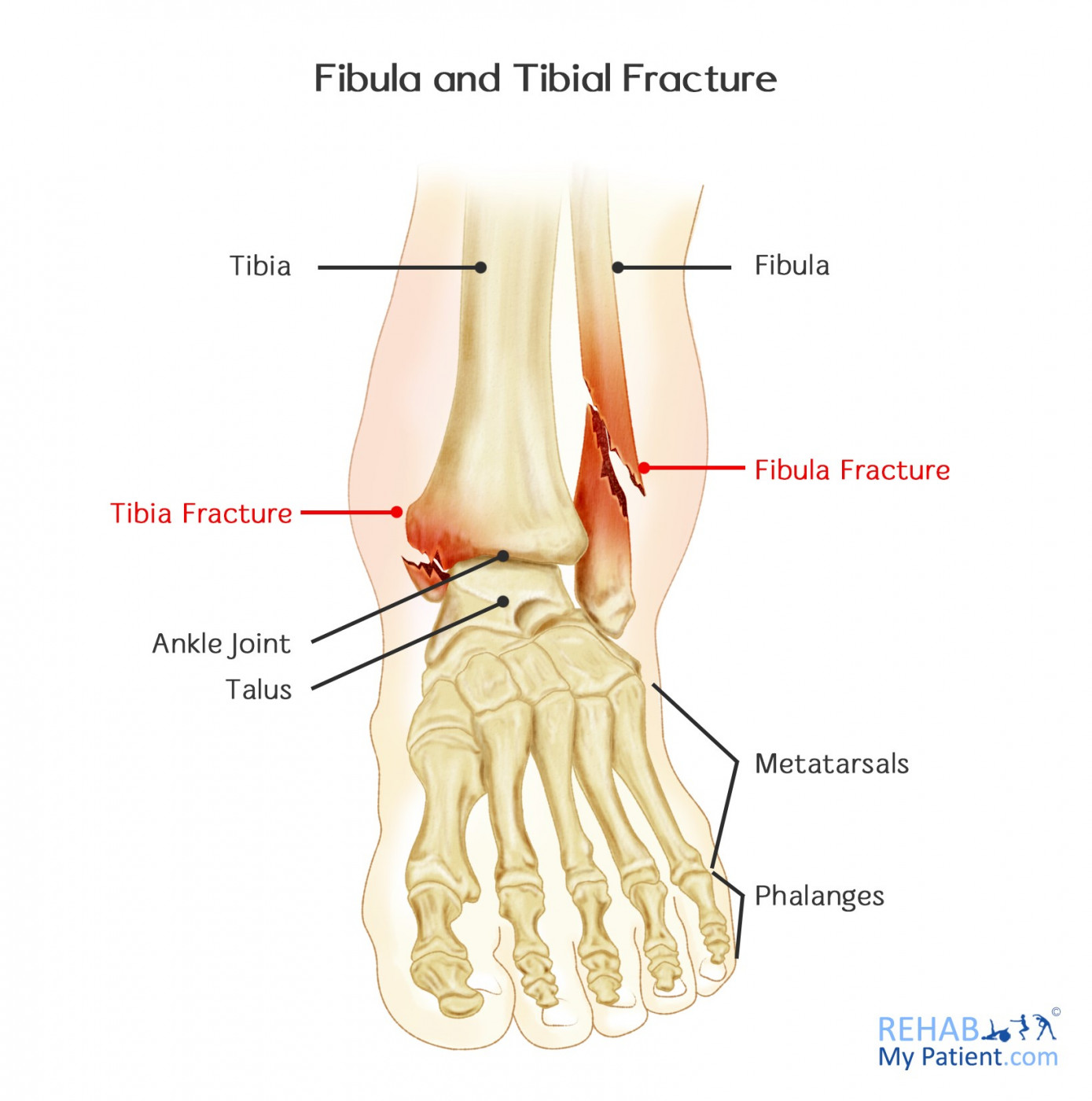 Can You Walk On A Broken Fibula After 4 Weeks Fibula And Tibial Fracture Rehab My Patient