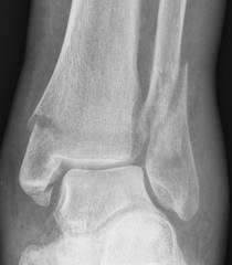 Fibula and Tibial Fracture X-Ray