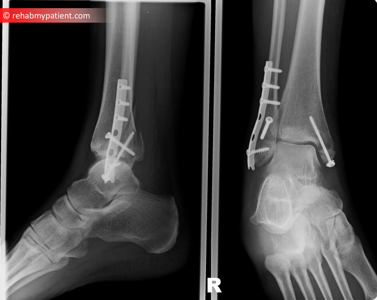 Fibula and Tibial Fracture | Rehab My Patient