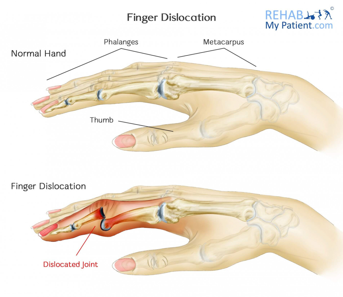 Finger Dislocation