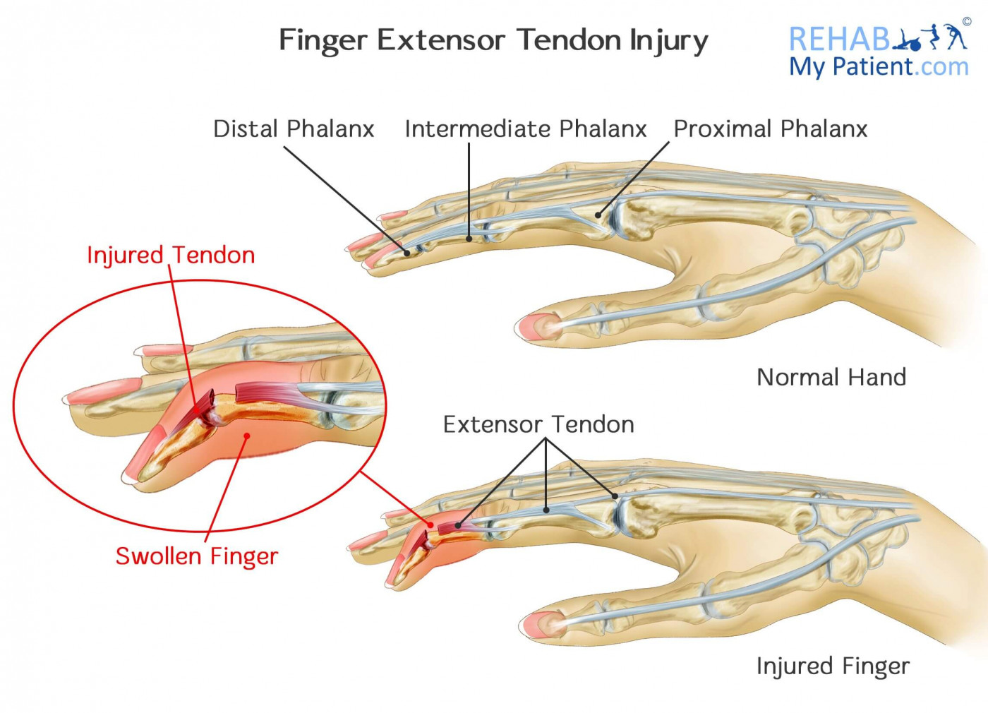 Finger Extensor Tendon Injury