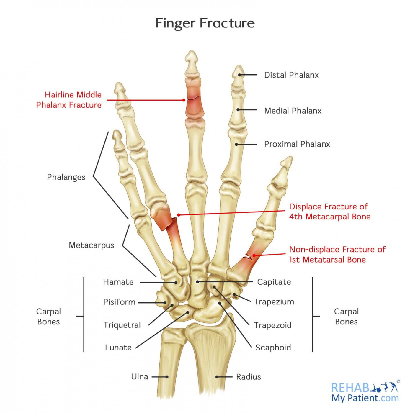 Fracture finger