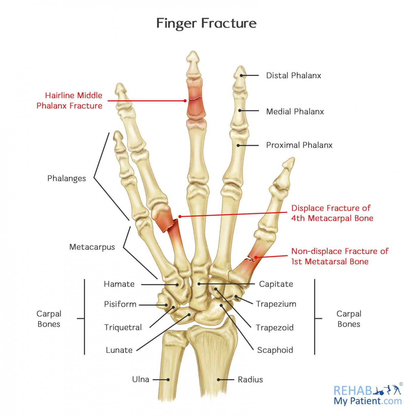 Finger Fracture | Rehab My Patient