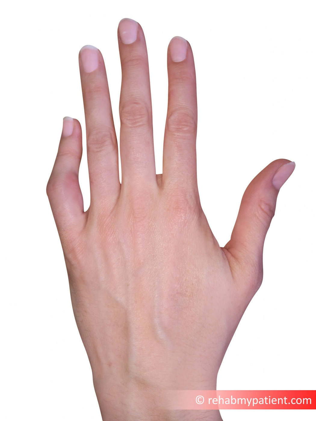 Finger Proximal Interphalangeal (PIP) Joint Dislocation