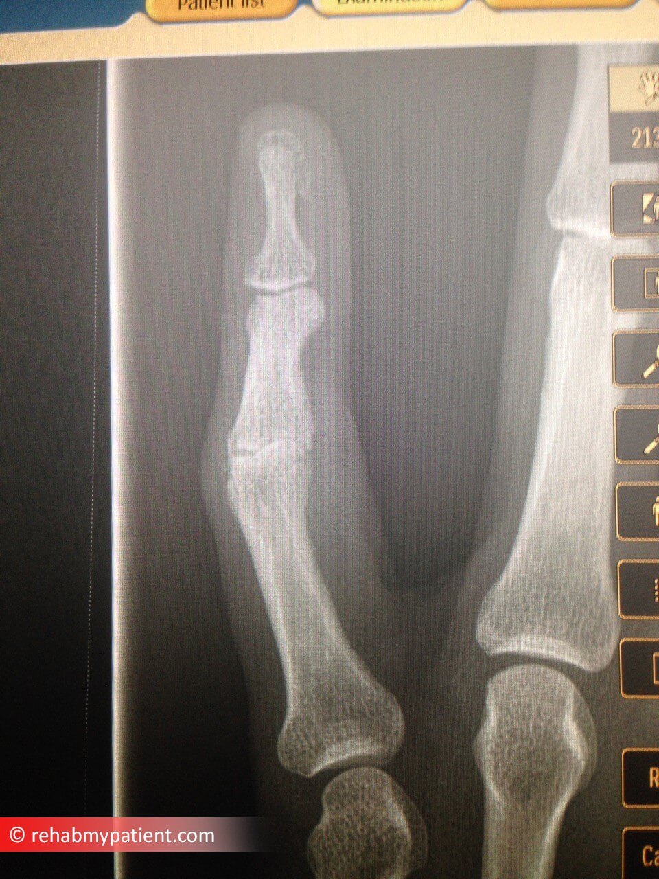 Finger Proximal Interphalangeal (PIP) Joint Dislocation X-Ray
