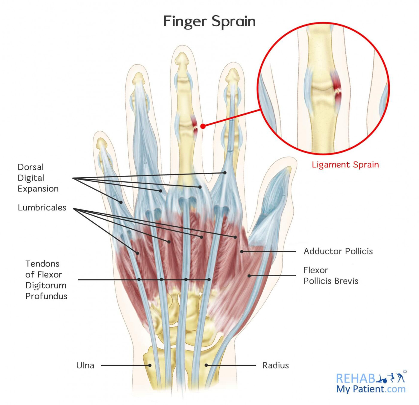 Finger Sprain