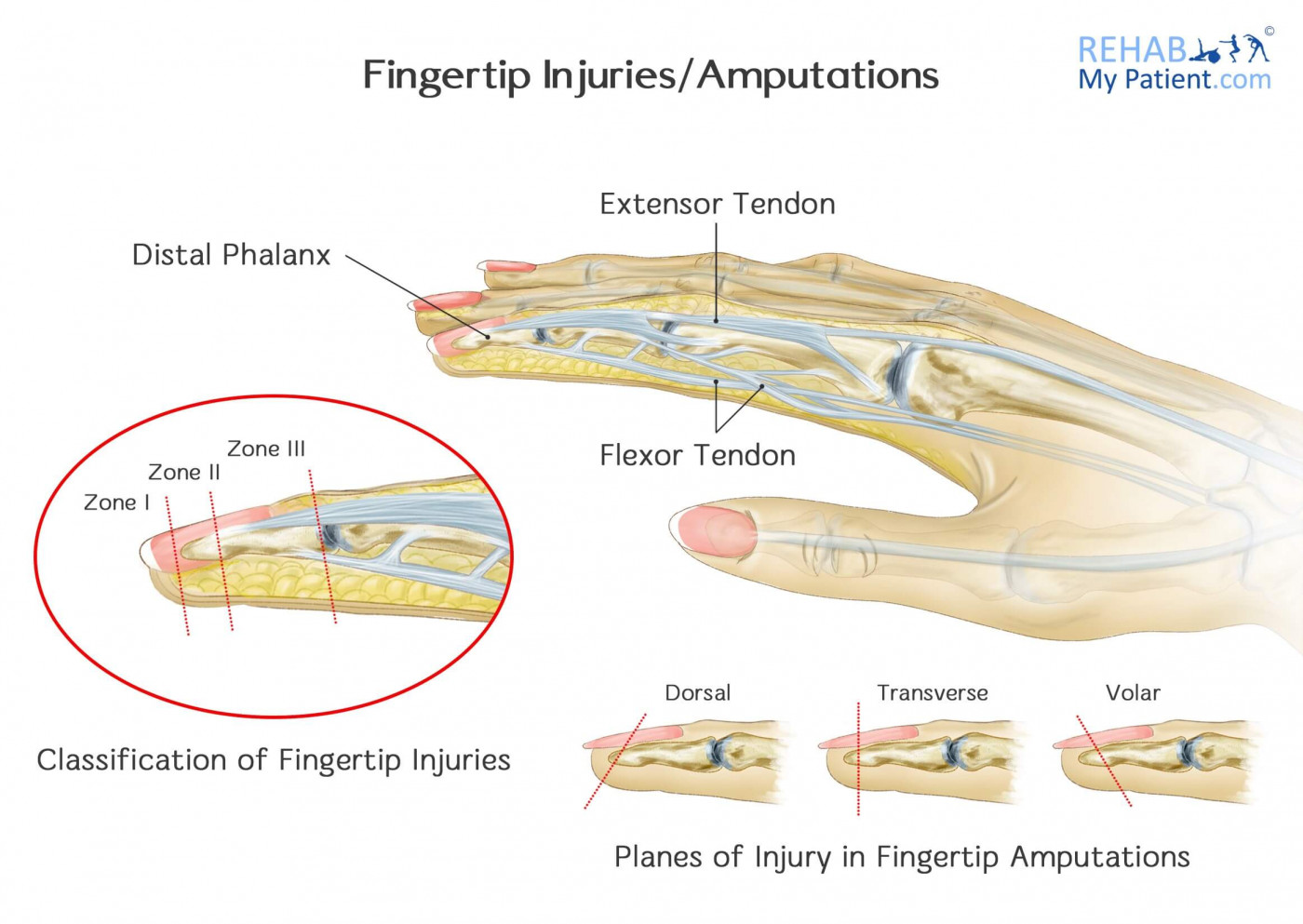 Fingertip Injury Amputation