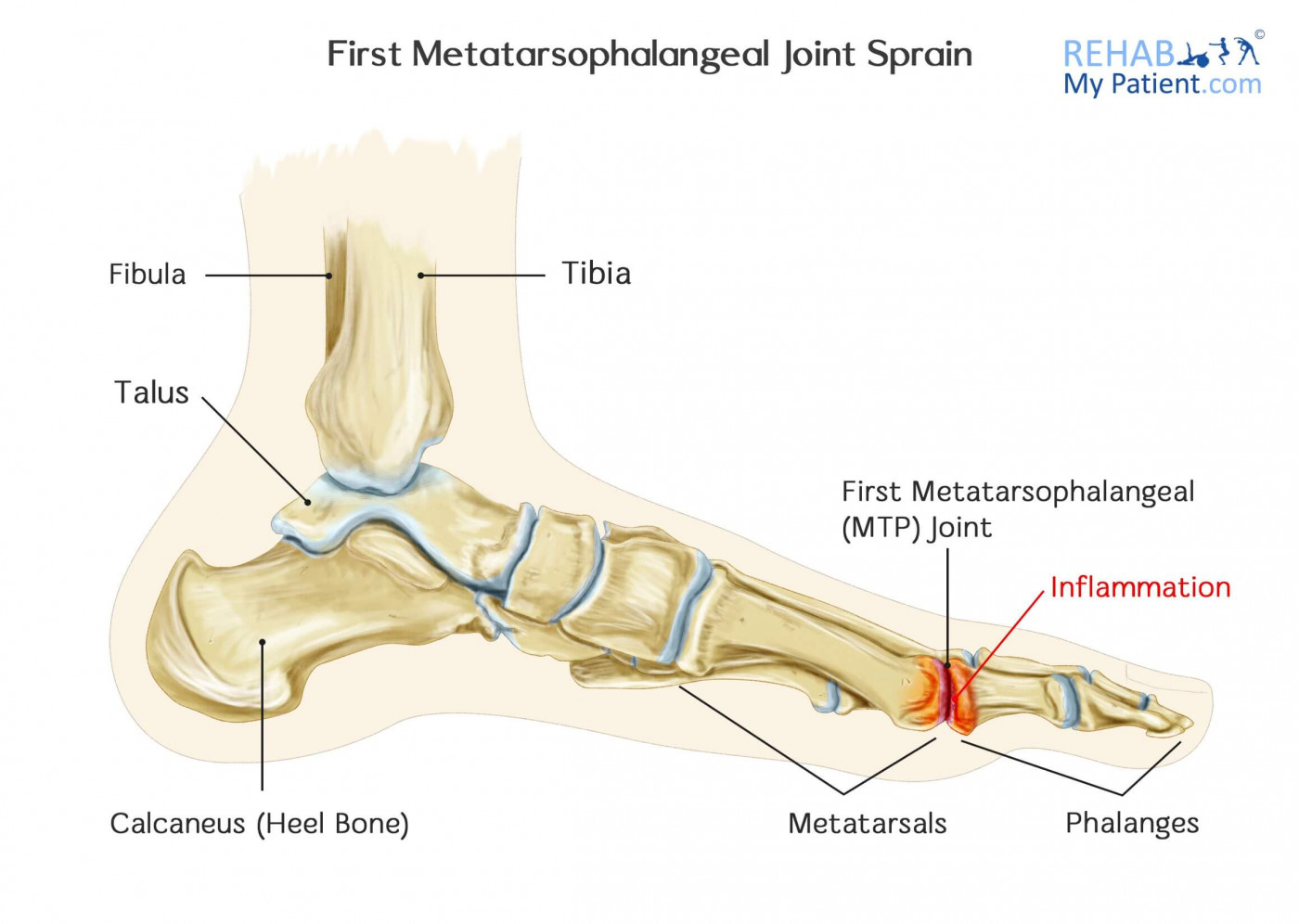 First Metatarsophalangeal Joint Sprain | Rehab My Patient