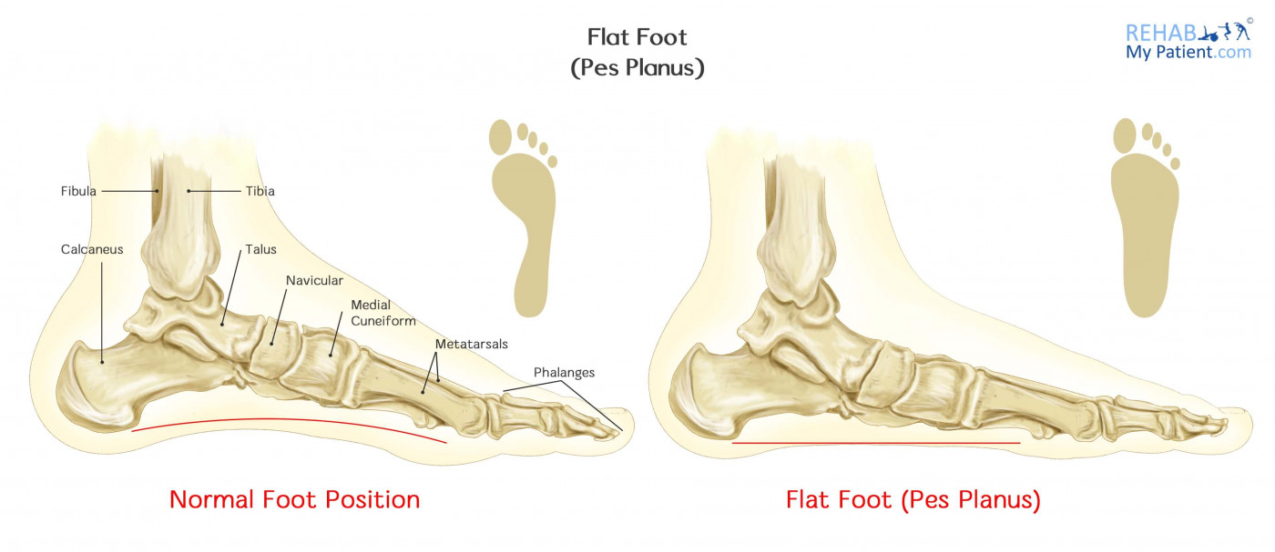 Flat Foot Pes Planus