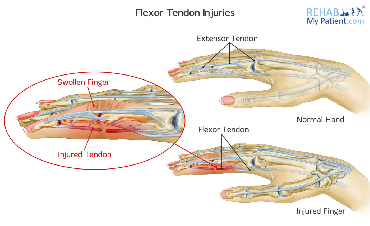 Flexor Tendon Injuries