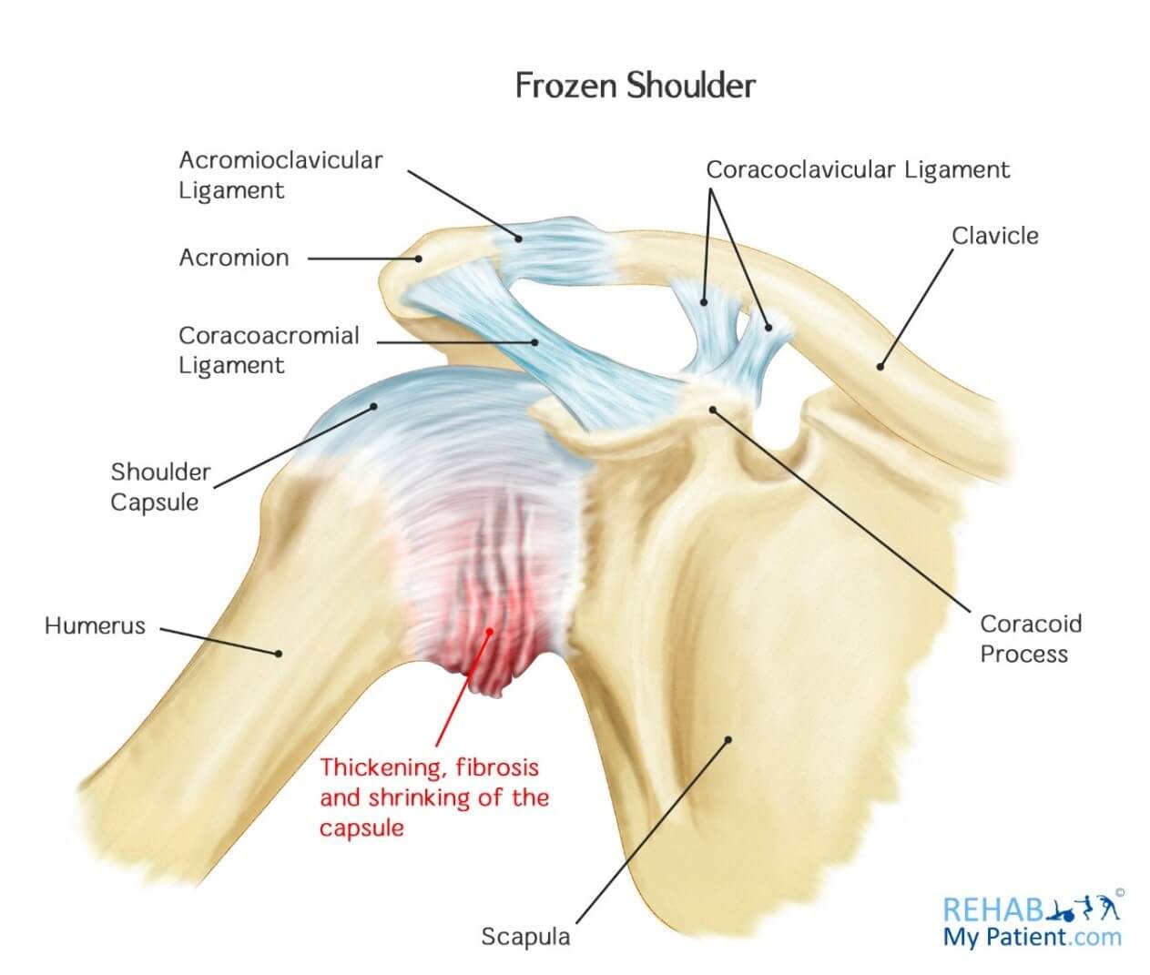 Frozen Shoulder