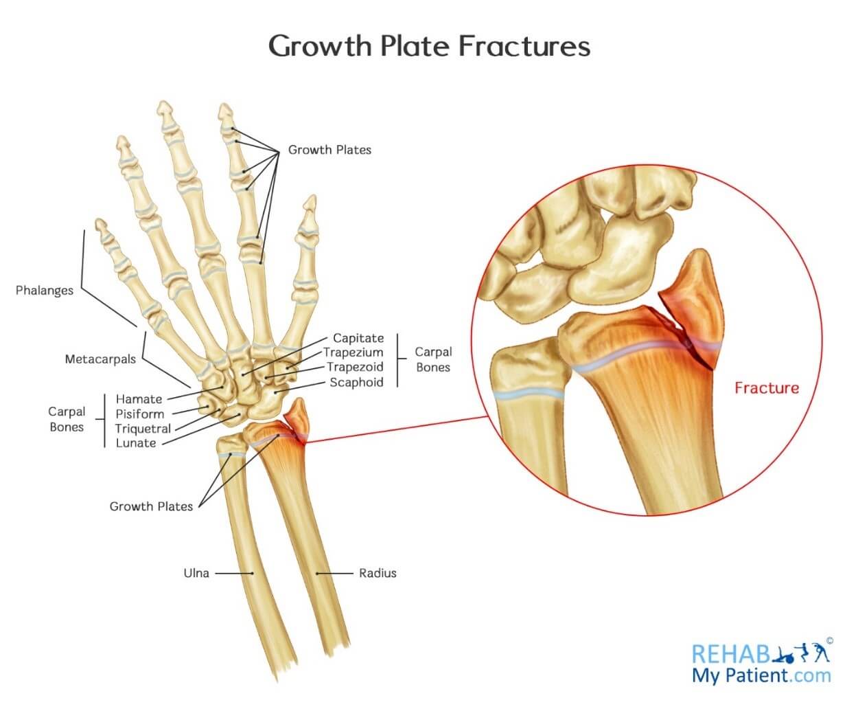 Growth Plate Fractures Rehab My Patient