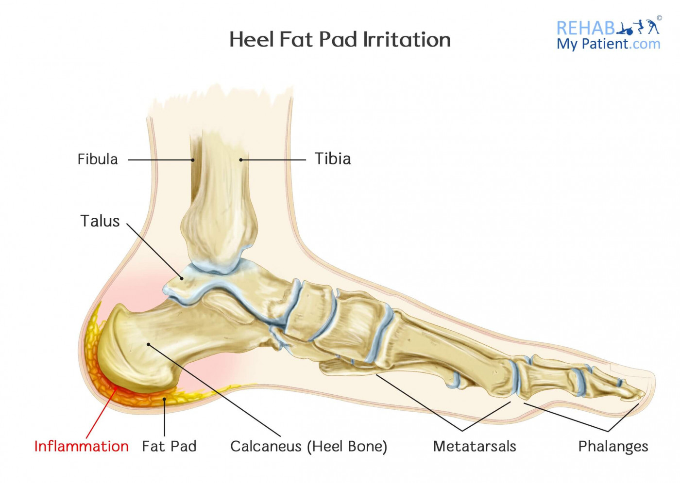 Heel Fat Pad Irritation/Syndrome 