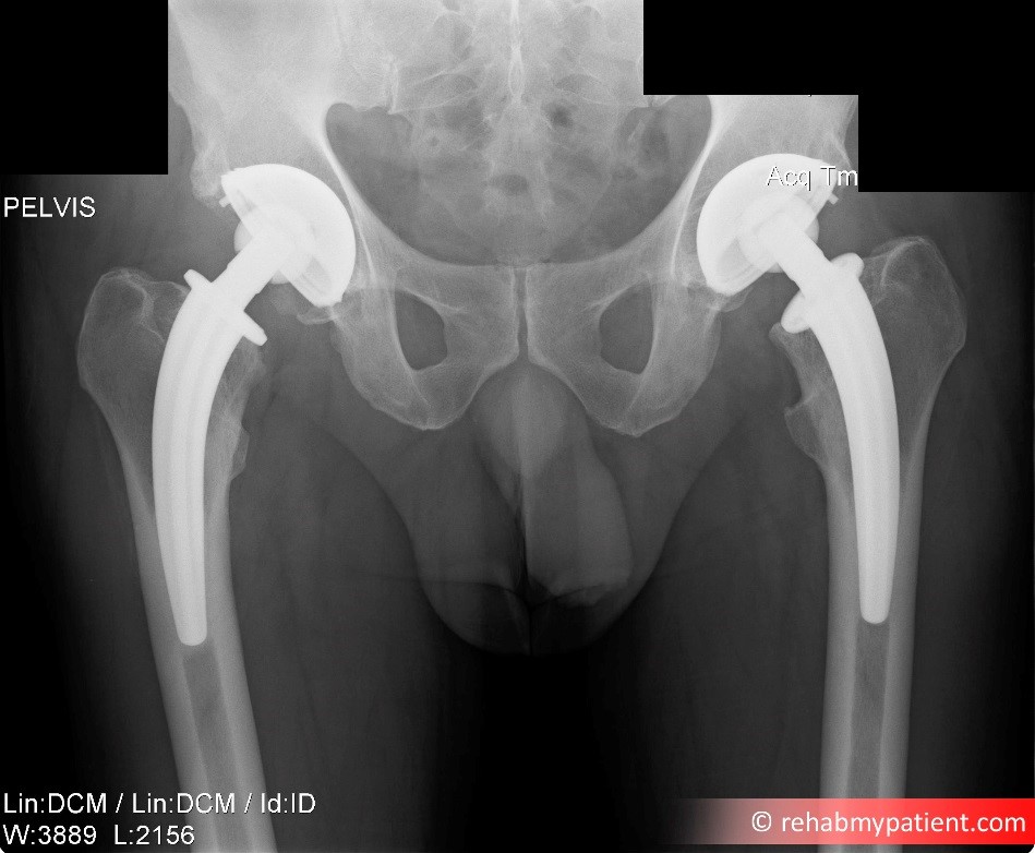An X-ray showing bilateral hip replacement