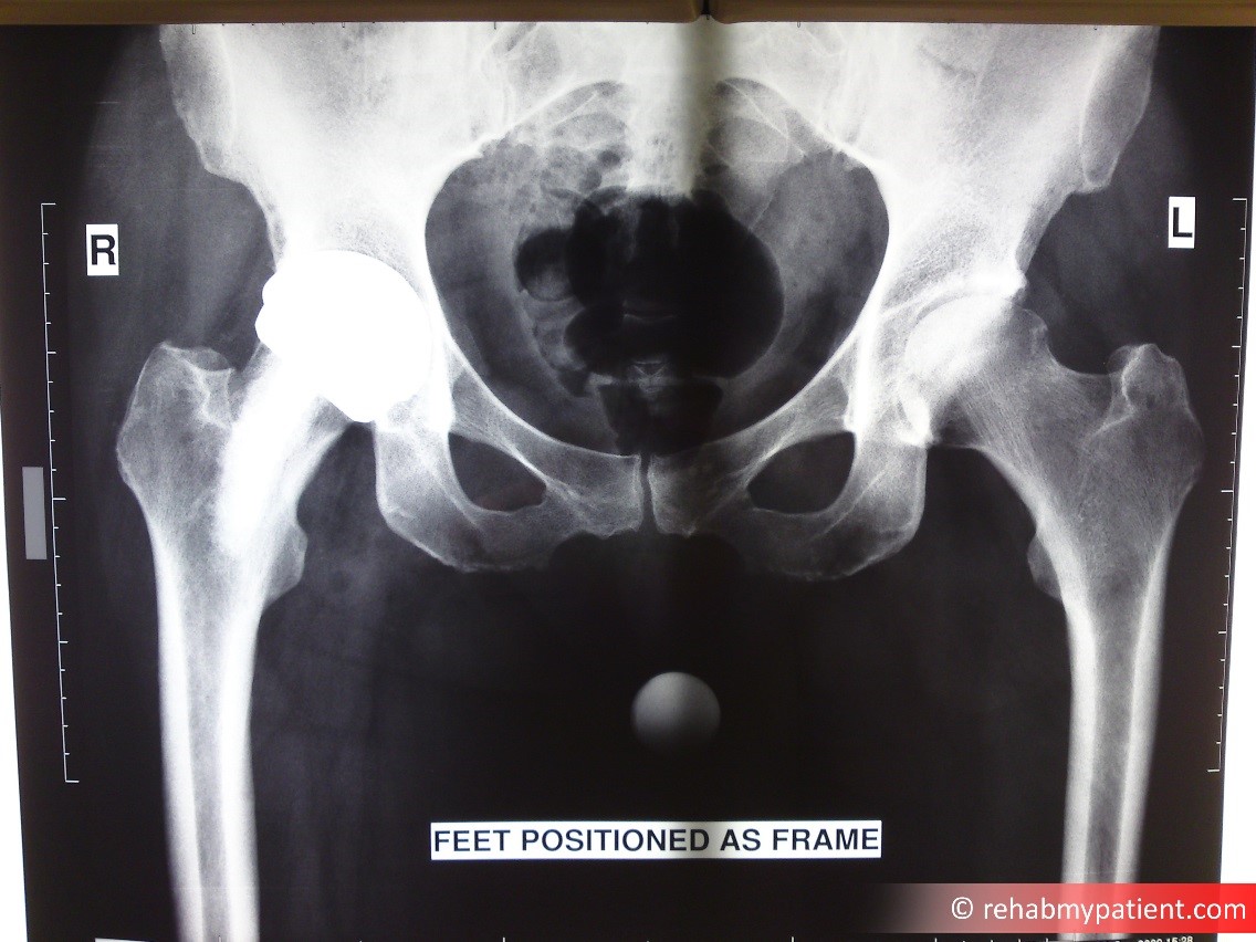 An X-Ray showing a total hip replacement on the right side.  There is also moderate osteoarthritis on the left hip.