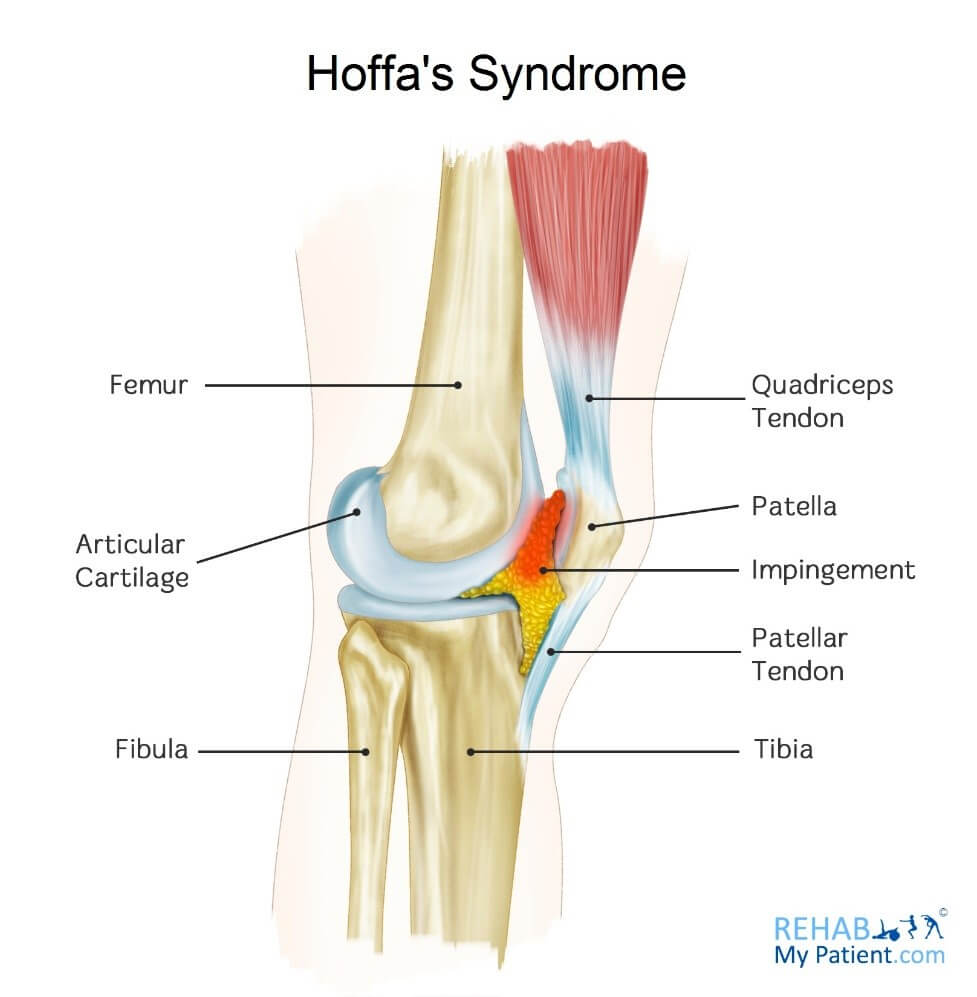 Hoffa's Syndrome