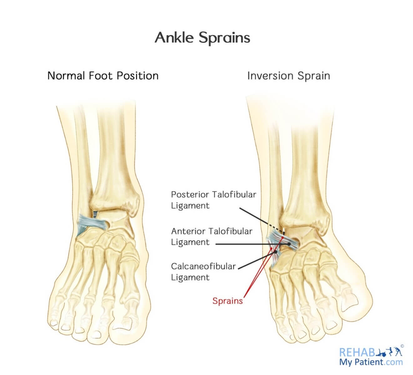 Ankle Sprain Causes, Sprained Ankle