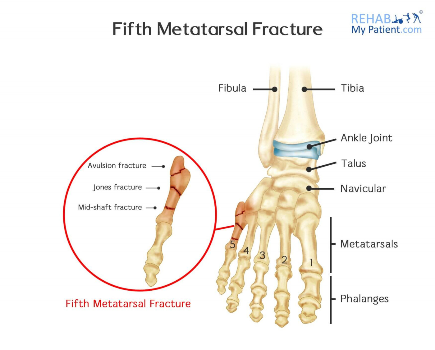 Jones Fracture Rehab My Patient