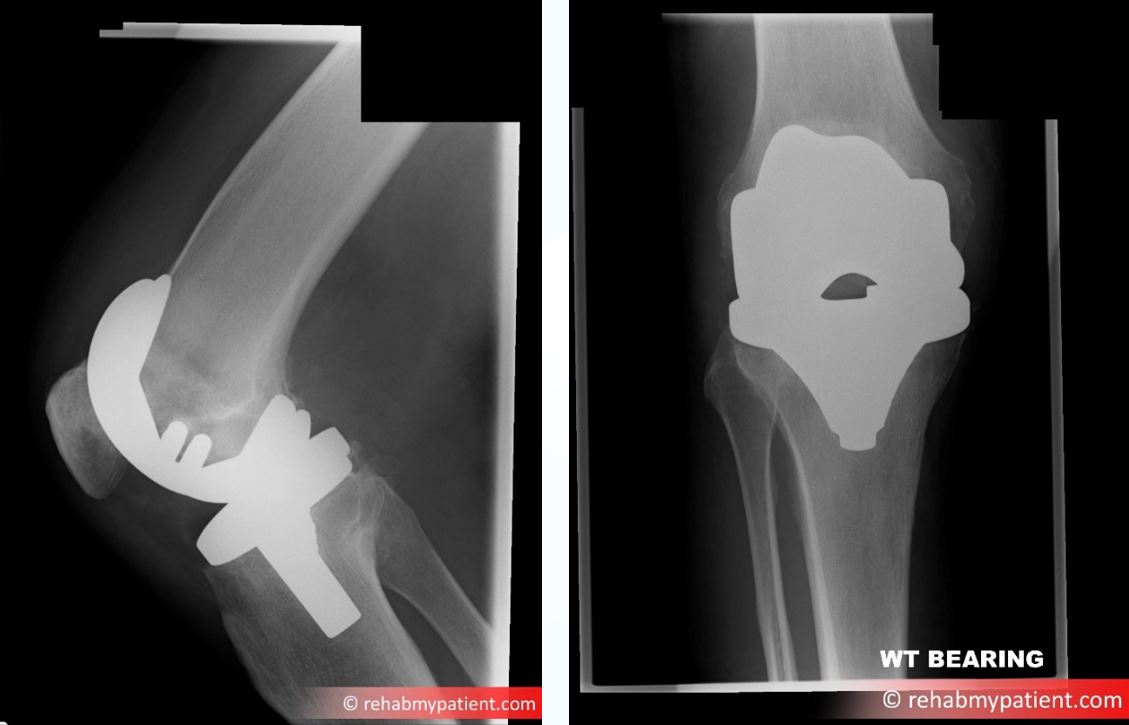 knee replacement x ray