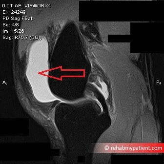 Knee Bursitis MRI