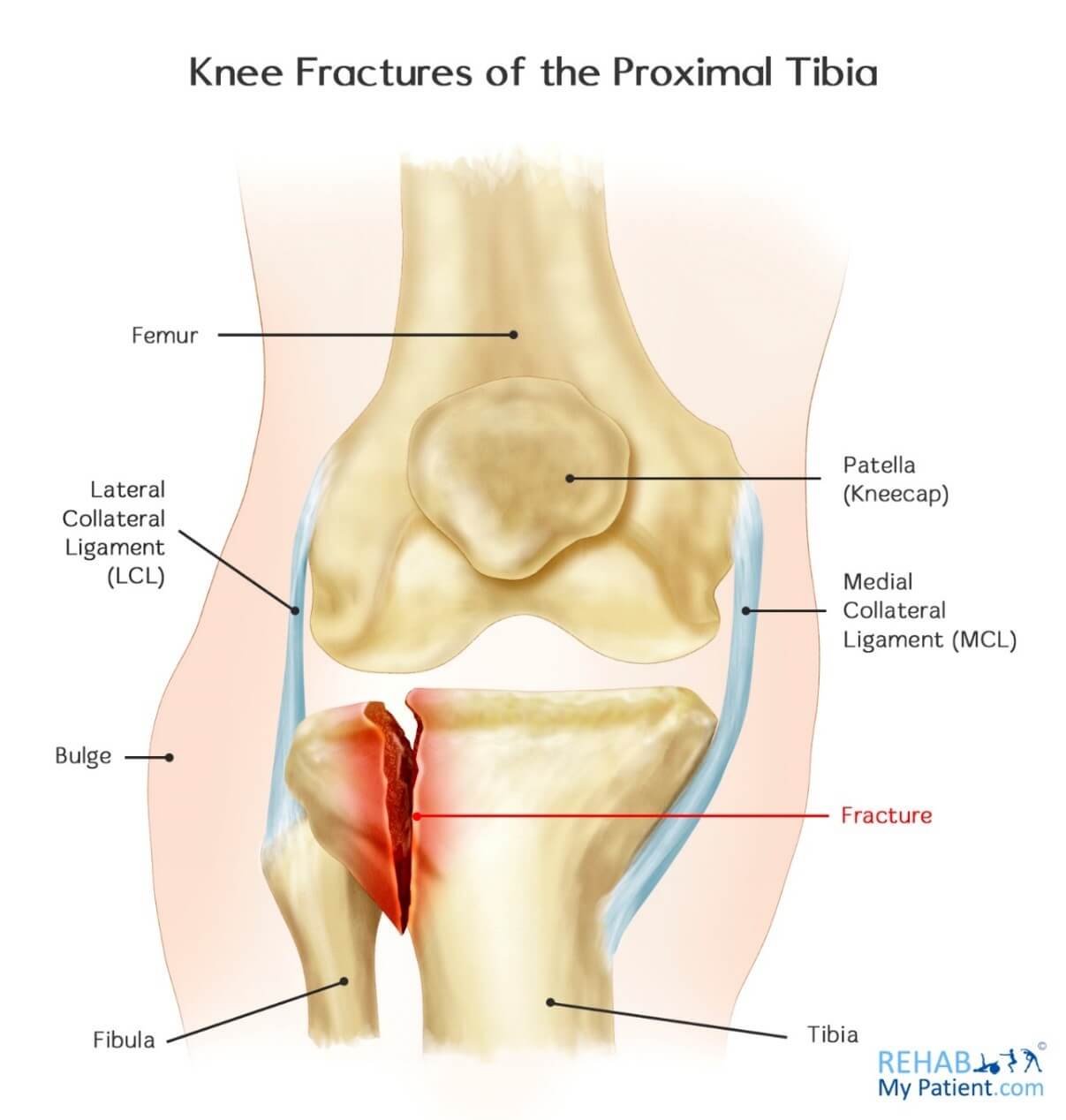 knee_fractures_of_the_proximal_tibia.jpg