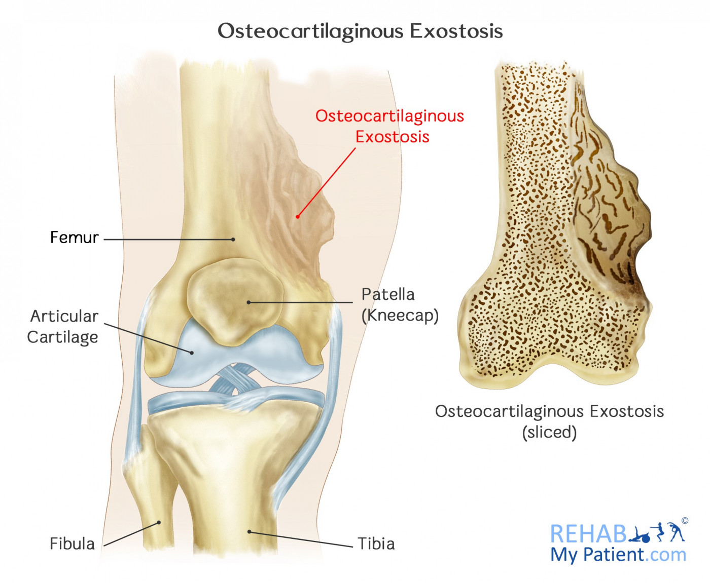 Osteocartilaginous Exostosis