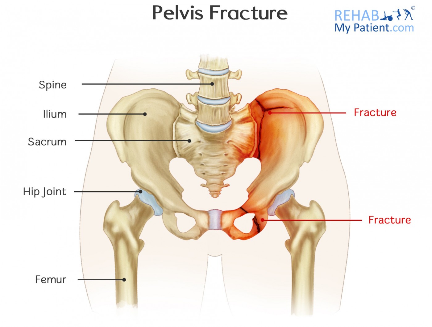 Pelvis Fracture  Rehab My Patient