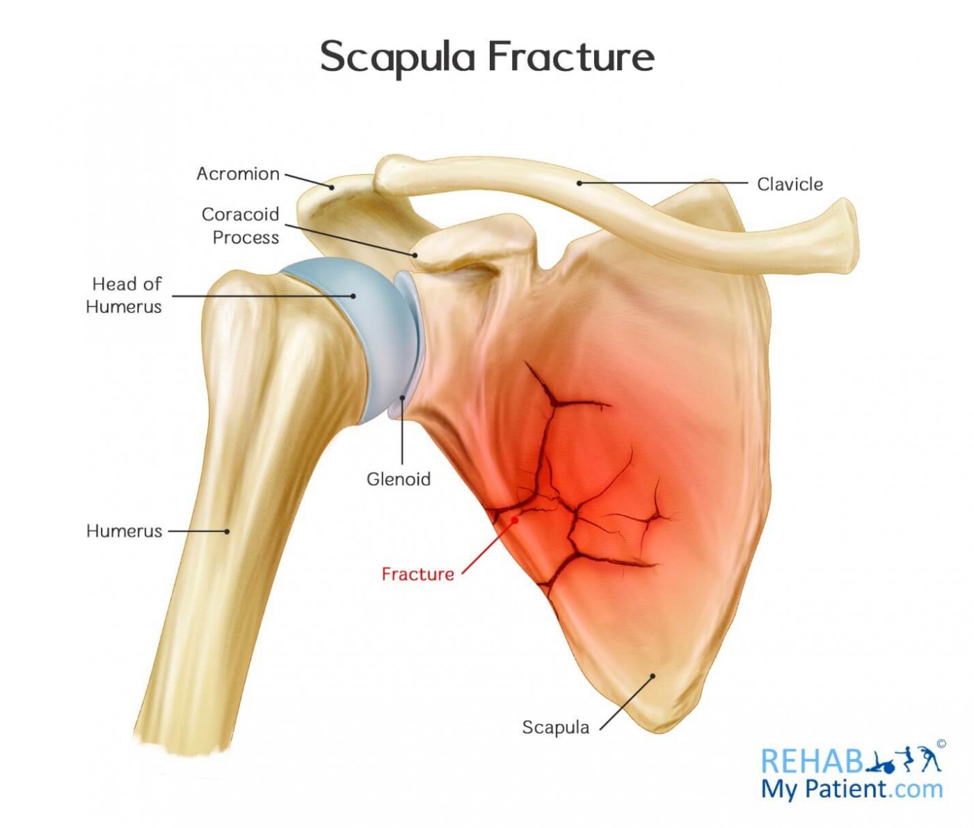 Scapula Fracture