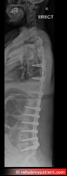 X-ray showing post-surgical treatment for severe scoliosis