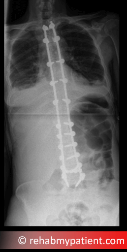 X-ray showing post-surgical treatment for severe scoliosis