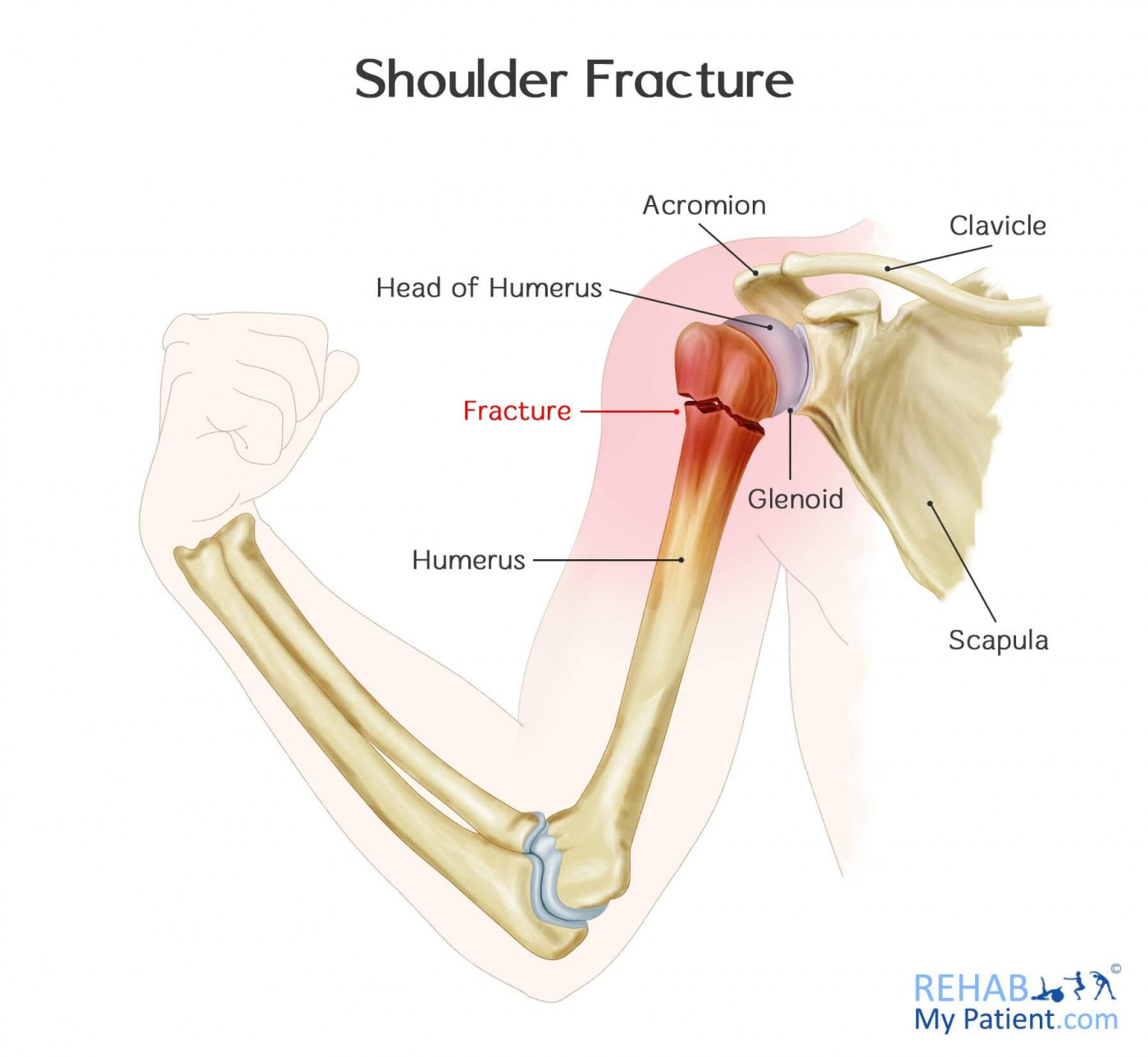 Shoulder Fracture