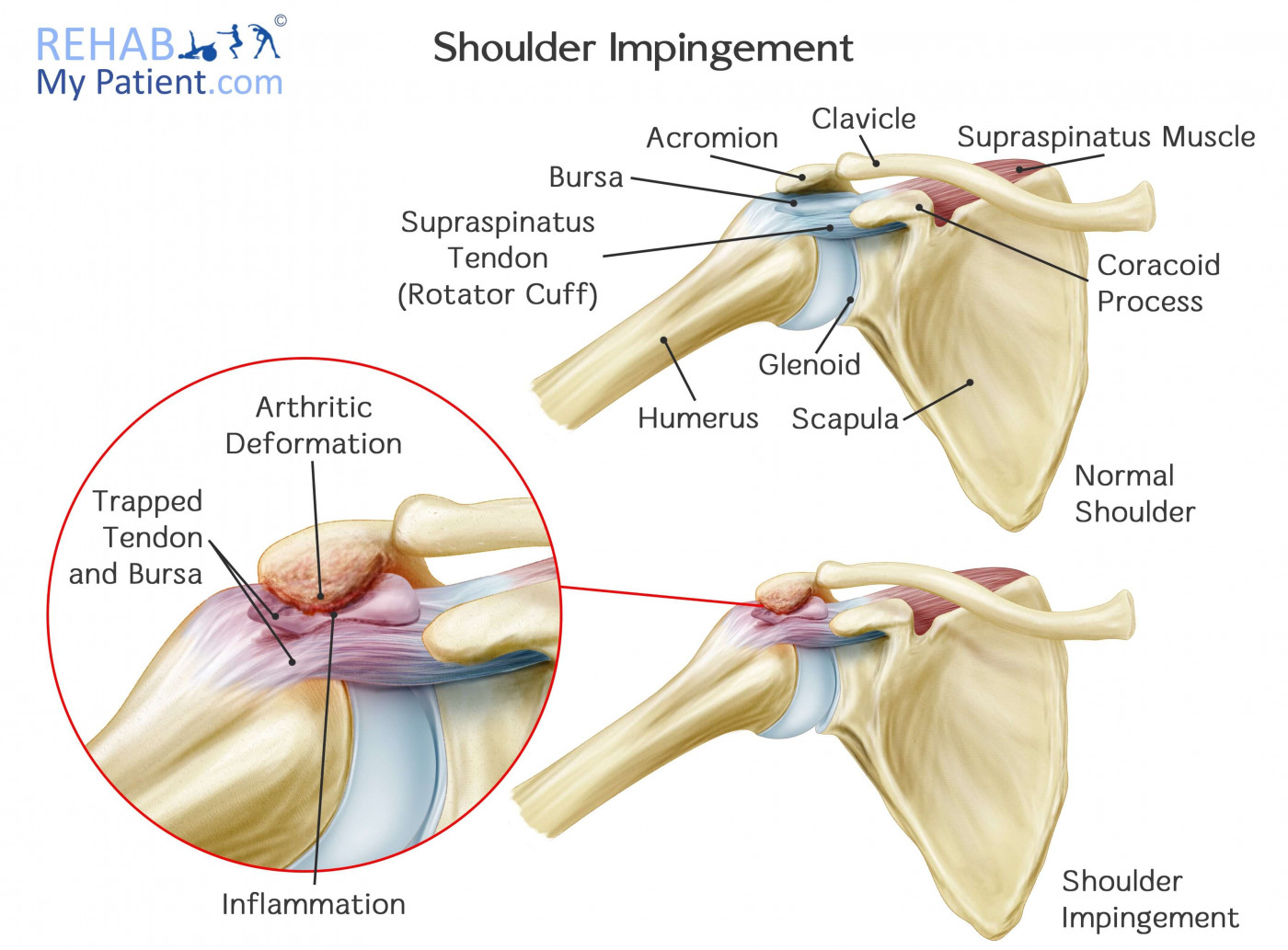 shoulder impingement diagnosis