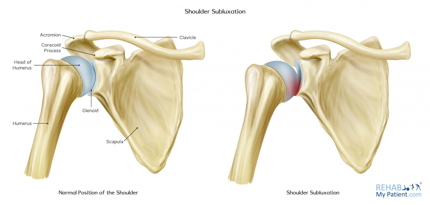 Shoulder Subluxation