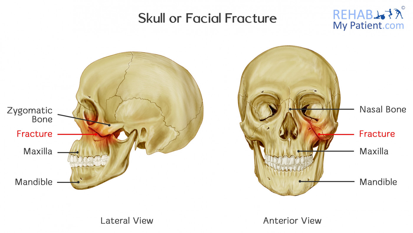 Skull or Facial Fracture